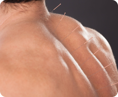Close-up of acupuncture needles inserted into a patient's back for pain relief treatment in New York City