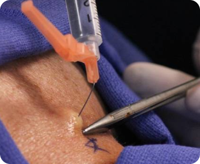 Cervical Epidural Steroid Injection (ESI) Treatment NYC