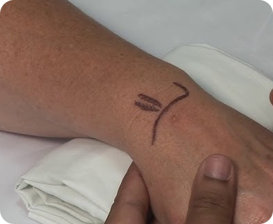Healthcare professional marking the site for a hand injection treatment, preparing for the procedure in New York City