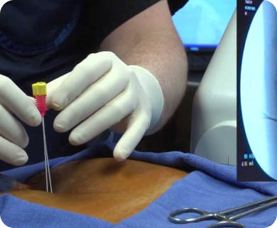 Healthcare professional performing a needle insertion guided by fluoroscopy for spinal treatment, with a focus on the procedure in New York City