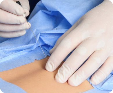 Close-up of a healthcare professional performing a needle insertion for spinal treatment, with focus on the needle and patient’s lower back in New York City