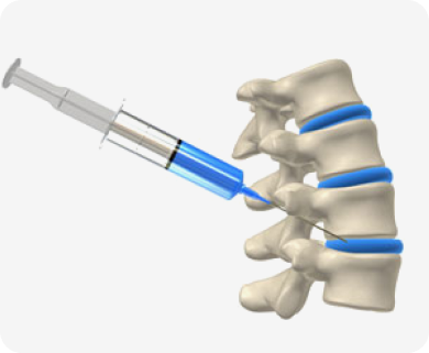 Illustration of a spinal epidural injection being administered to the spine, with focus on the syringe and spinal discs in New York City