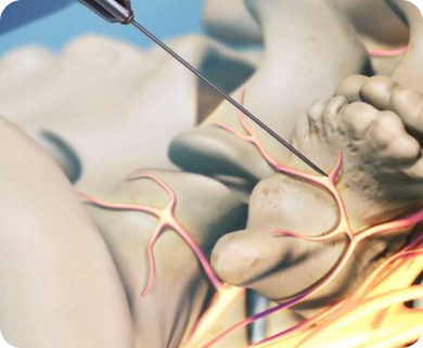 Close-up of a spinal injection treatment targeting nerves in the lower back, with a focus on the needle and nerve pathways in New York City