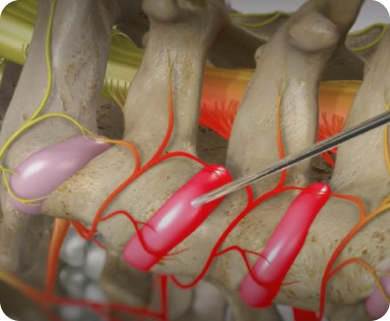 Close-up of a spinal nerve block procedure targeting nerve roots in the back, with the needle shown in New York City