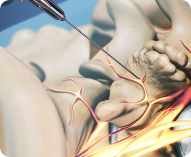 Close-up of a spinal nerve injection targeting nerve roots, with a focus on the needle and nerve pathways in New York City