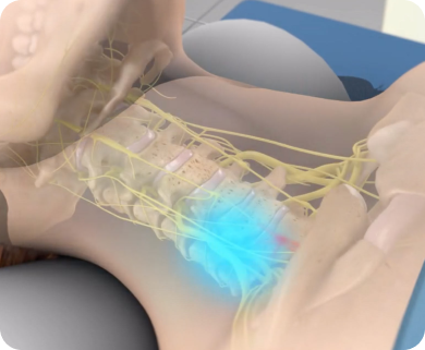 Illustration of a spinal nerve treatment targeting the lower back, with a focus on nerve pathways in New York City