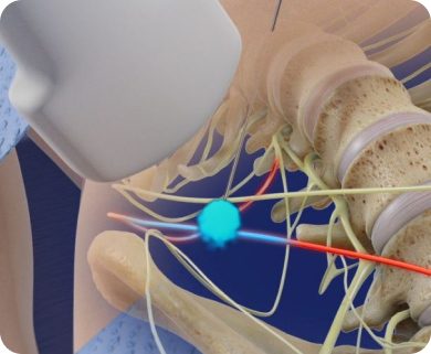 Illustration of a spinal radiofrequency nerve ablation procedure targeting nerve roots to alleviate pain, with a focus on the treatment area in New York City