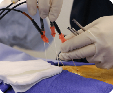 Close-up of a spinal radiofrequency nerve ablation procedure being performed, with multiple needles inserted in New York City