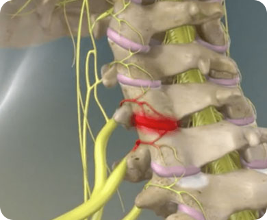 Close-up of a spinal nerve block procedure targeting a nerve root in the lower back, with a focus on the treatment area in New York City