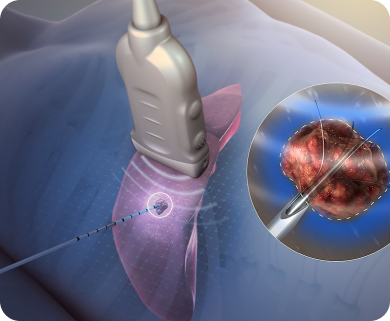 Close-up of ultrasound-guided needle insertion for biopsy or treatment of a tumor, with focus on the needle and targeted area in New York City